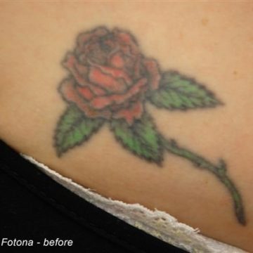 Before Tattoo Laser Removal
